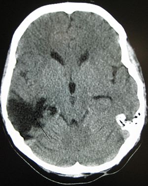 Brain Injury.